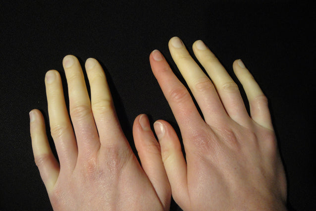 Aandoening: ziekte van Raynaud