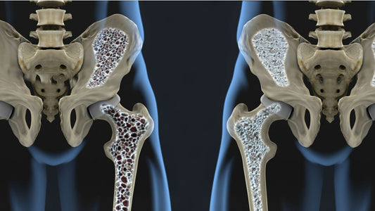 Aandoening: osteoporose (botontkalking)