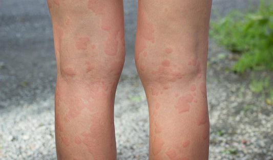 Histamine-intolerantie en allergieën