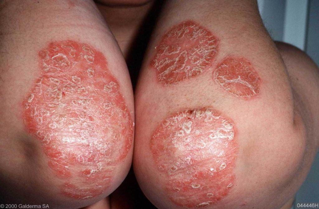 Aandoening: psoriasis, eczeem of rosacea