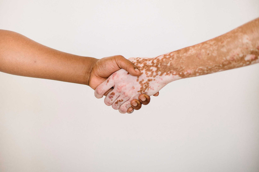 Aandoening: vitiligo en pityriasis versicolor